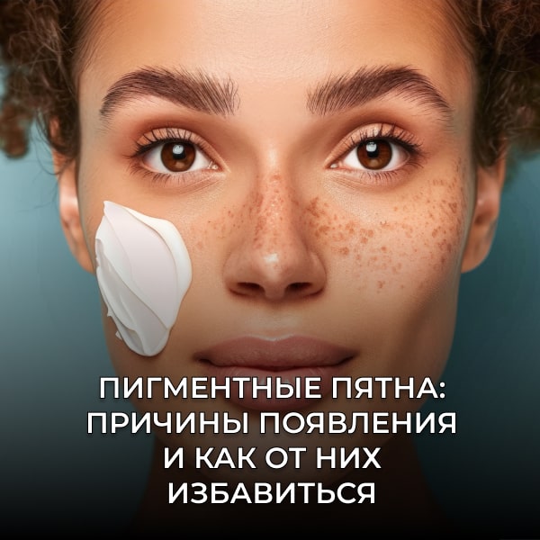 Пигментные пятна: причины появления и как от них избавиться